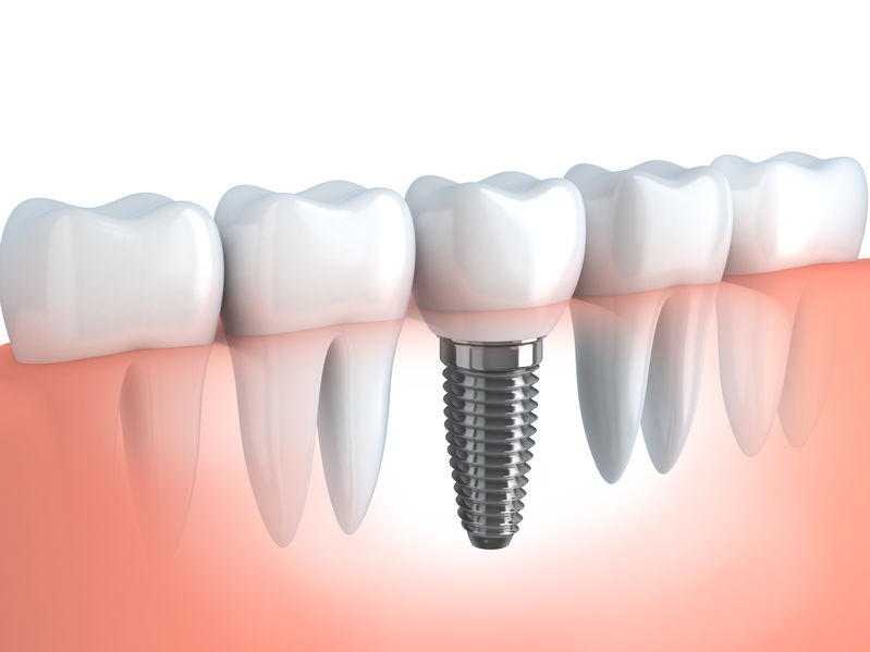 dental implants Castle Rock