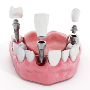 affordable dental implants Parker